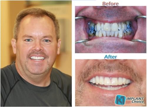 K1 Implant Choice - All on 4 - Full Mouth Dental Implants in one Day
