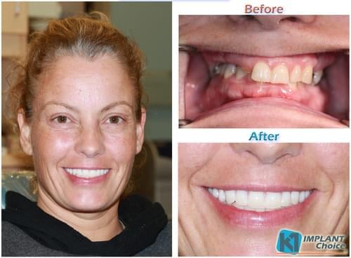 K1 Implant Choice - All on 4 - Full Mouth Dental Implants in one Day