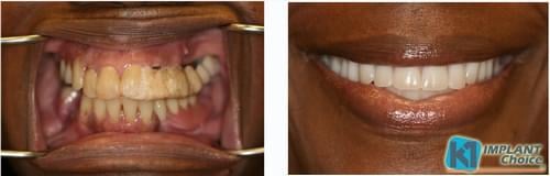 K1 Implant Choice - All on 4 - Full Mouth Dental Implants in one Day