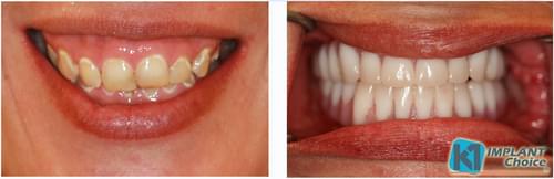 K1 Implant Choice - All on 4 - Full Mouth Dental Implants in one Day